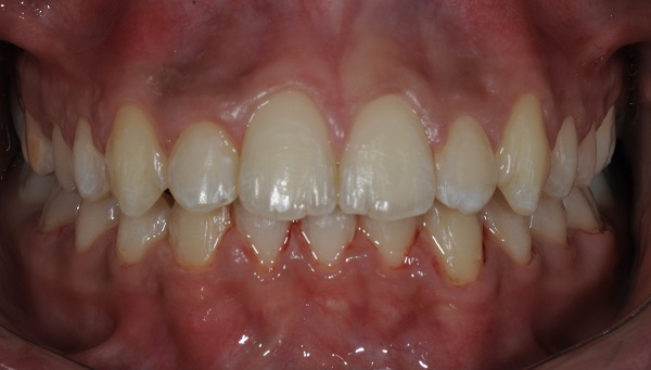 After-Orthodontics-and-Aligners