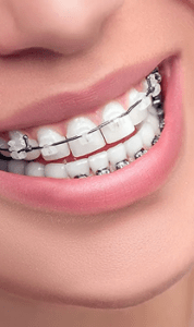 Orthodontics/ Aligners