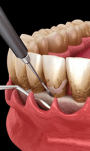 Periodontal (Gum) Treatments