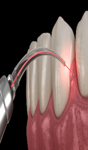 Laser Dentistry